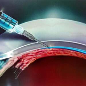 Suprachoroidal Space Injection Needle